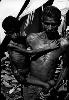 Extreme emaciation or Marasmus: Photograph courtesy of the U.S. CDC